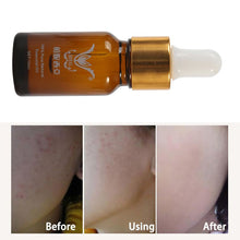 10ml Essence full-body whitening chicken skin repair essential oils remove dead skin goose bumps pimples folliculitis TIML66